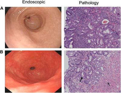 Transcriptome Analysis of lncRNA–mRNA Interactions in Chronic Atrophic Gastritis